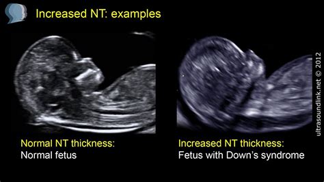 how to measure nuchal fold thickness|thick nuchal fold normal baby.